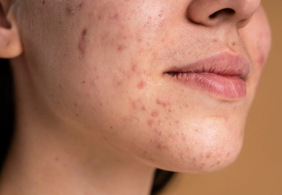 Miglior trattamento per acne e imperfezioni