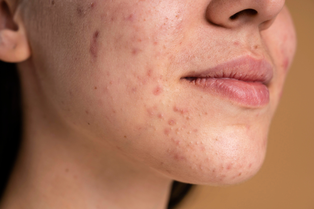 Miglior trattamento per acne e imperfezioni