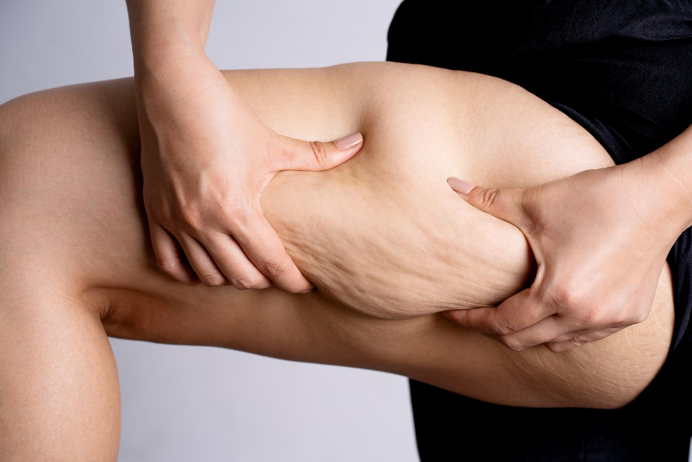 Cellulite massaggio linfodrenante